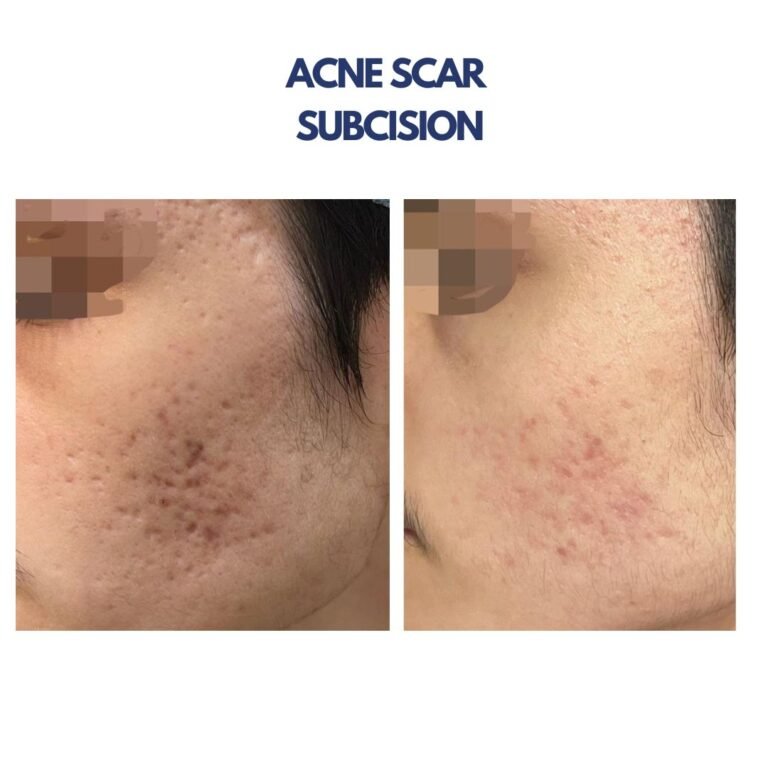 Acne Scar Subcision