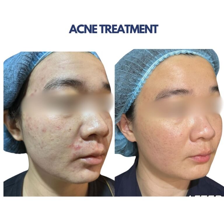 Acne Treatement