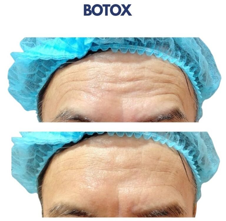 Botox