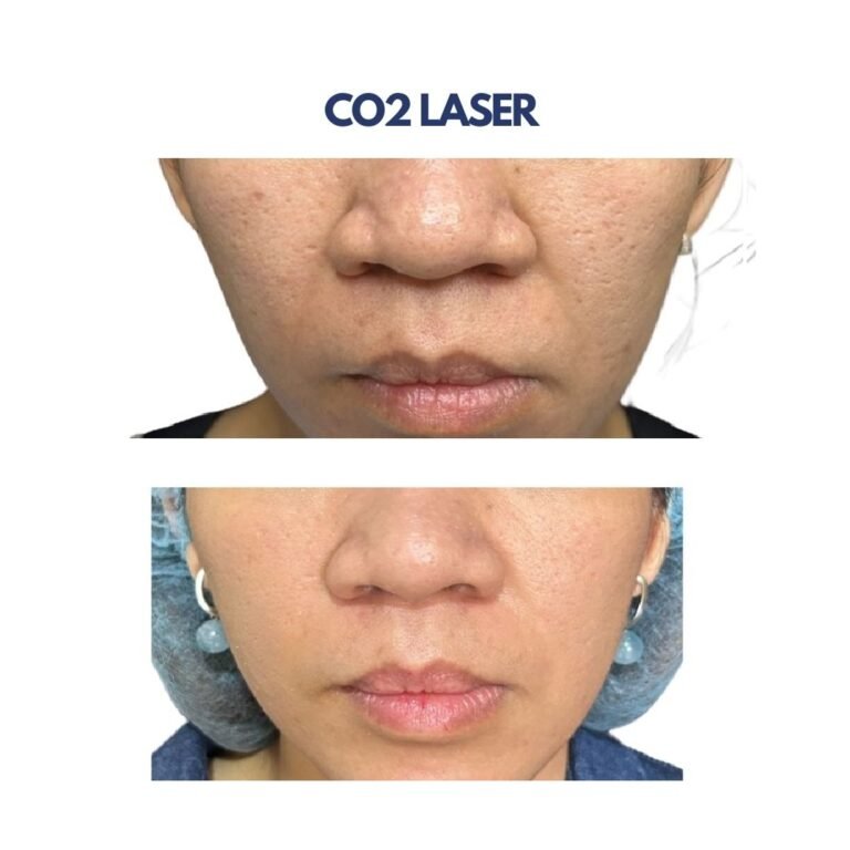 Co2 Laser