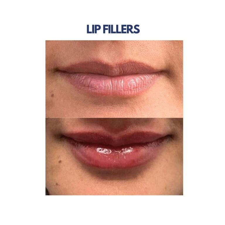 Lip Filler