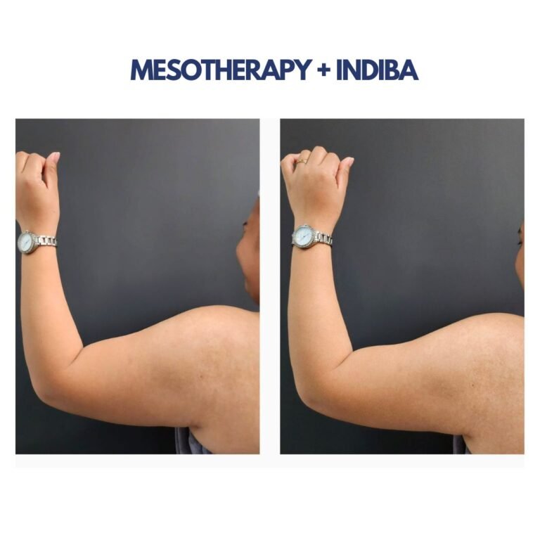 Mesotherapy