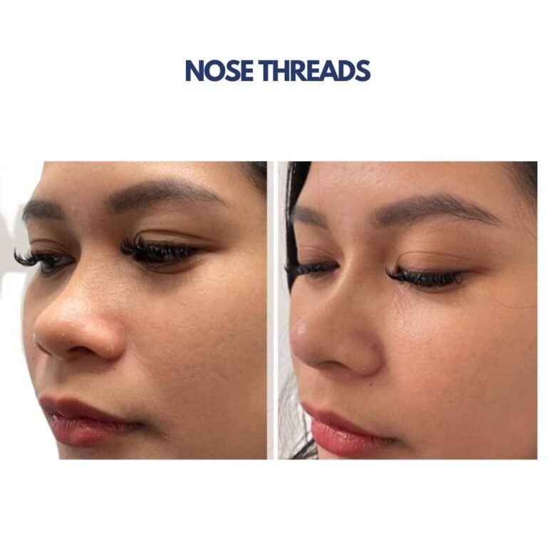 Nose Threads