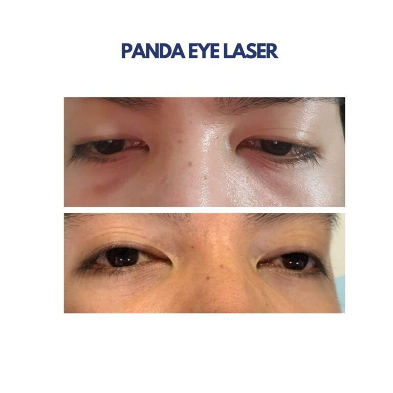 Panda Eye Laser
