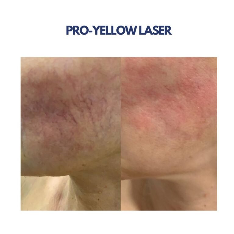 Pro-Yellow Laser