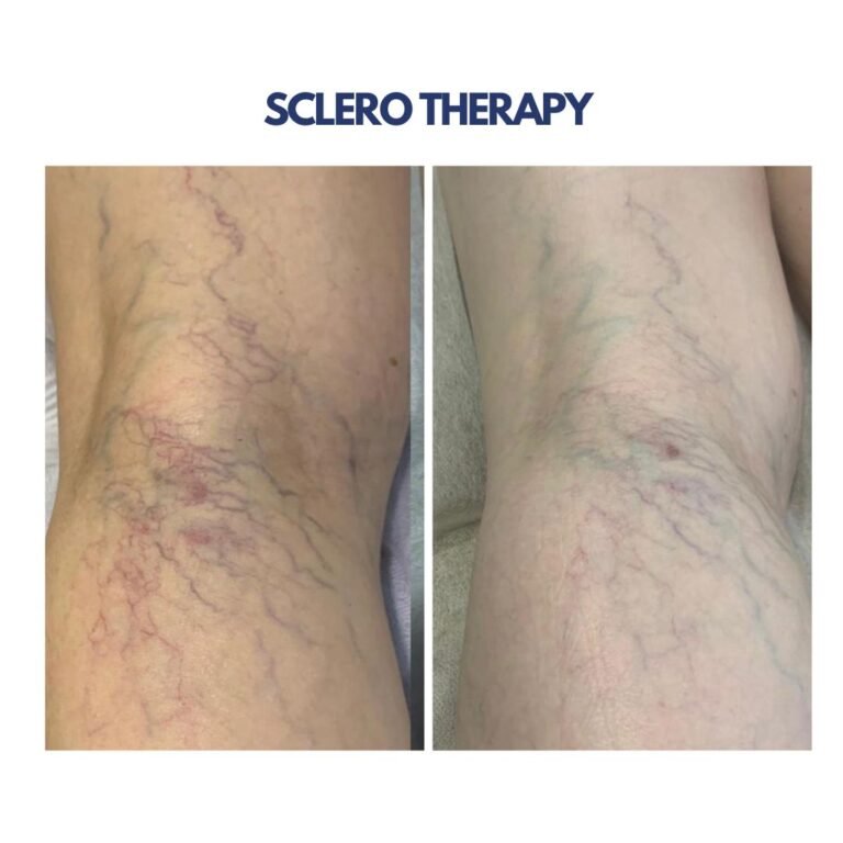 Sclero Therapy