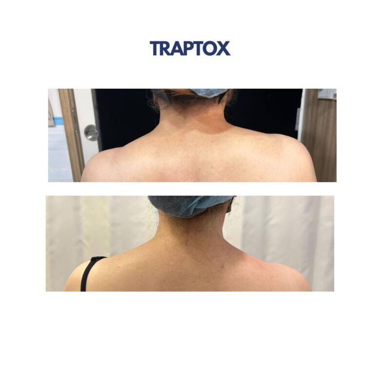 Traptox