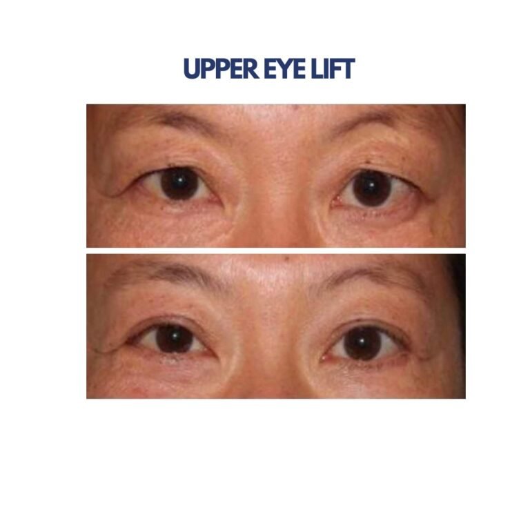 Upper Eye Lift