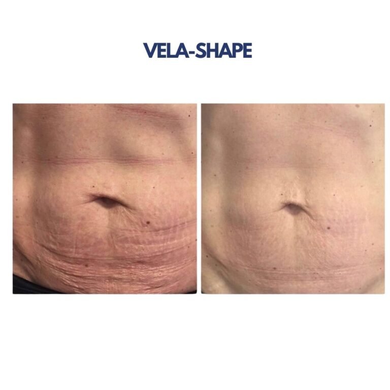 Vela-shape