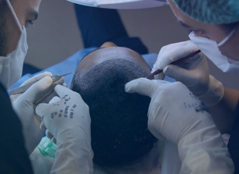 HAIR Transplant & Restoration (FUE) (1)